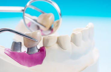 Crowns and Bridges Treatment in Bangalore