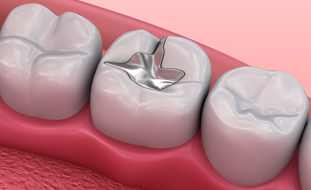 Restorative Dentistry in Bangalore