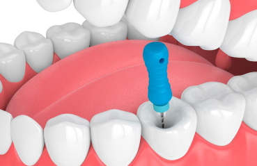 Root Canal Treatment Bangalore