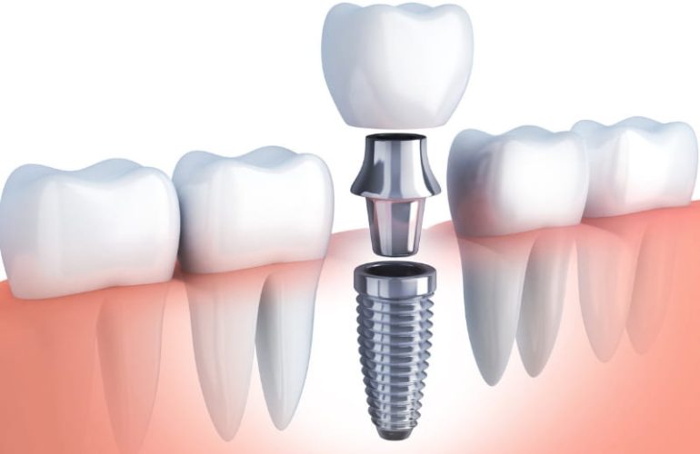 Dental Implants in Bangalore