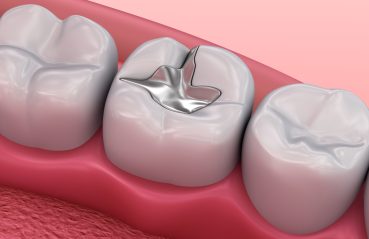 Restorative Dentistry in Bangalore
